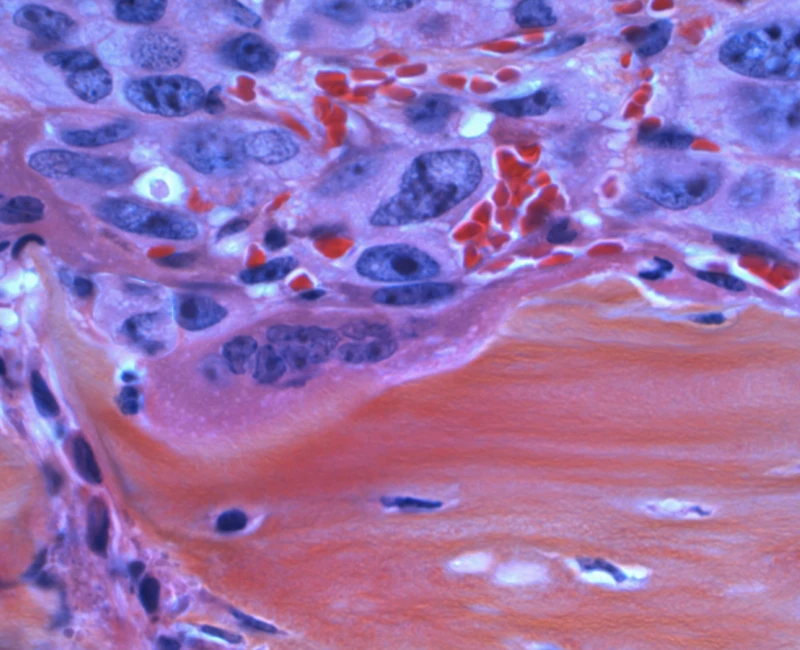 Cancer Spreading to the Bone