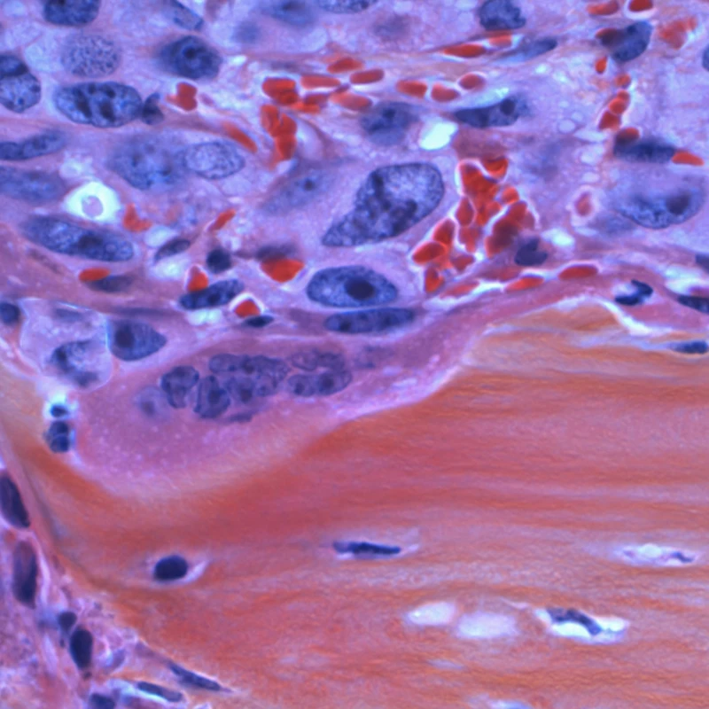 Cancer Spreading to the Bone